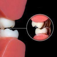 Bruxism