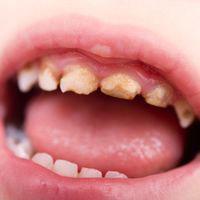 Tooth Decay