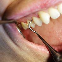Gum Disease