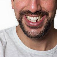 Missing Teeth