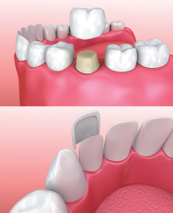 Dental match